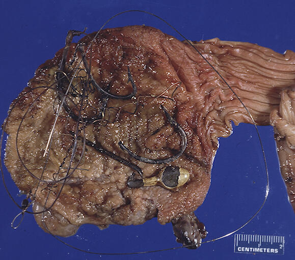 Image: Pelican Stomach: Injested Objects