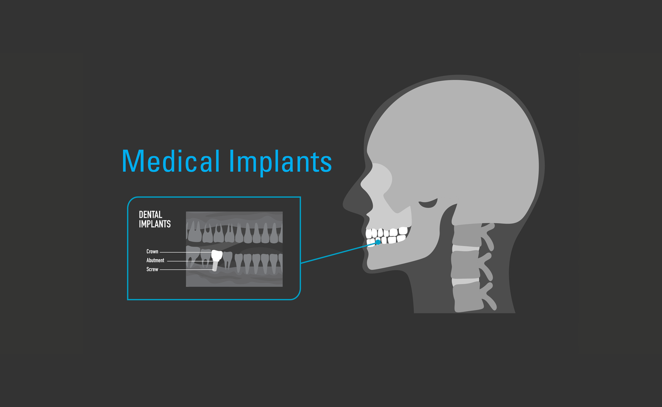 graphic of skull with closeup of dental implant