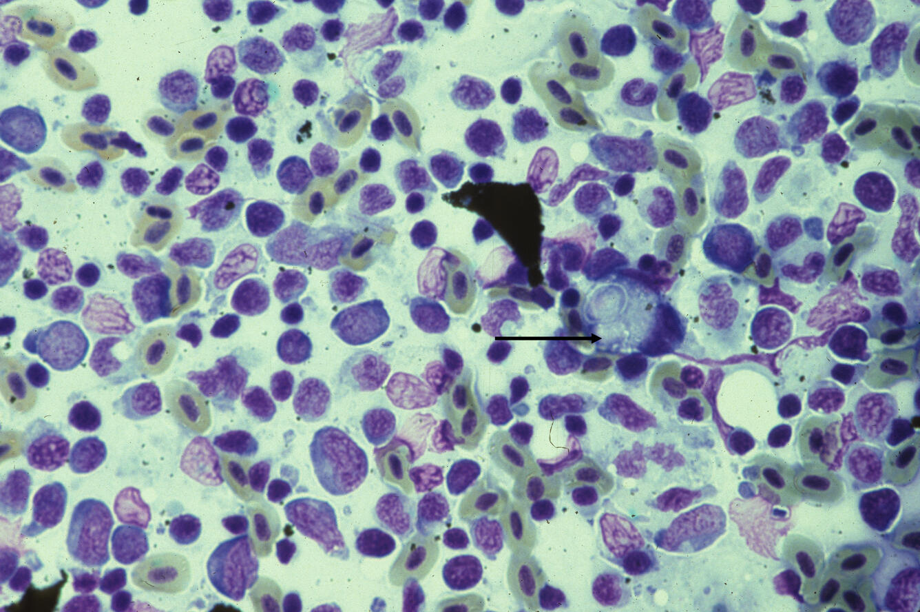 Proliferative kidney disease (PKD)