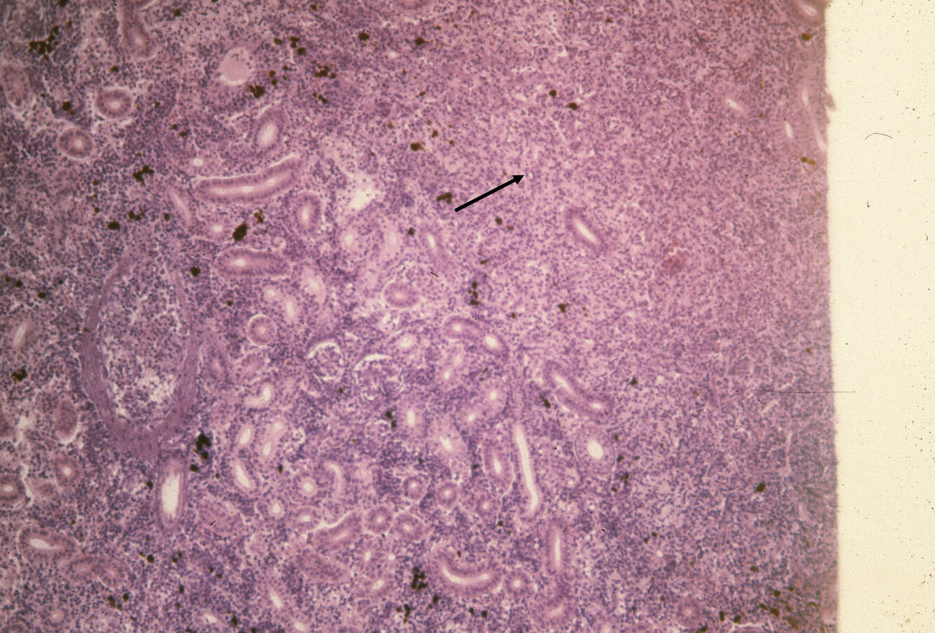 Proliferative kidney disease (PKD)