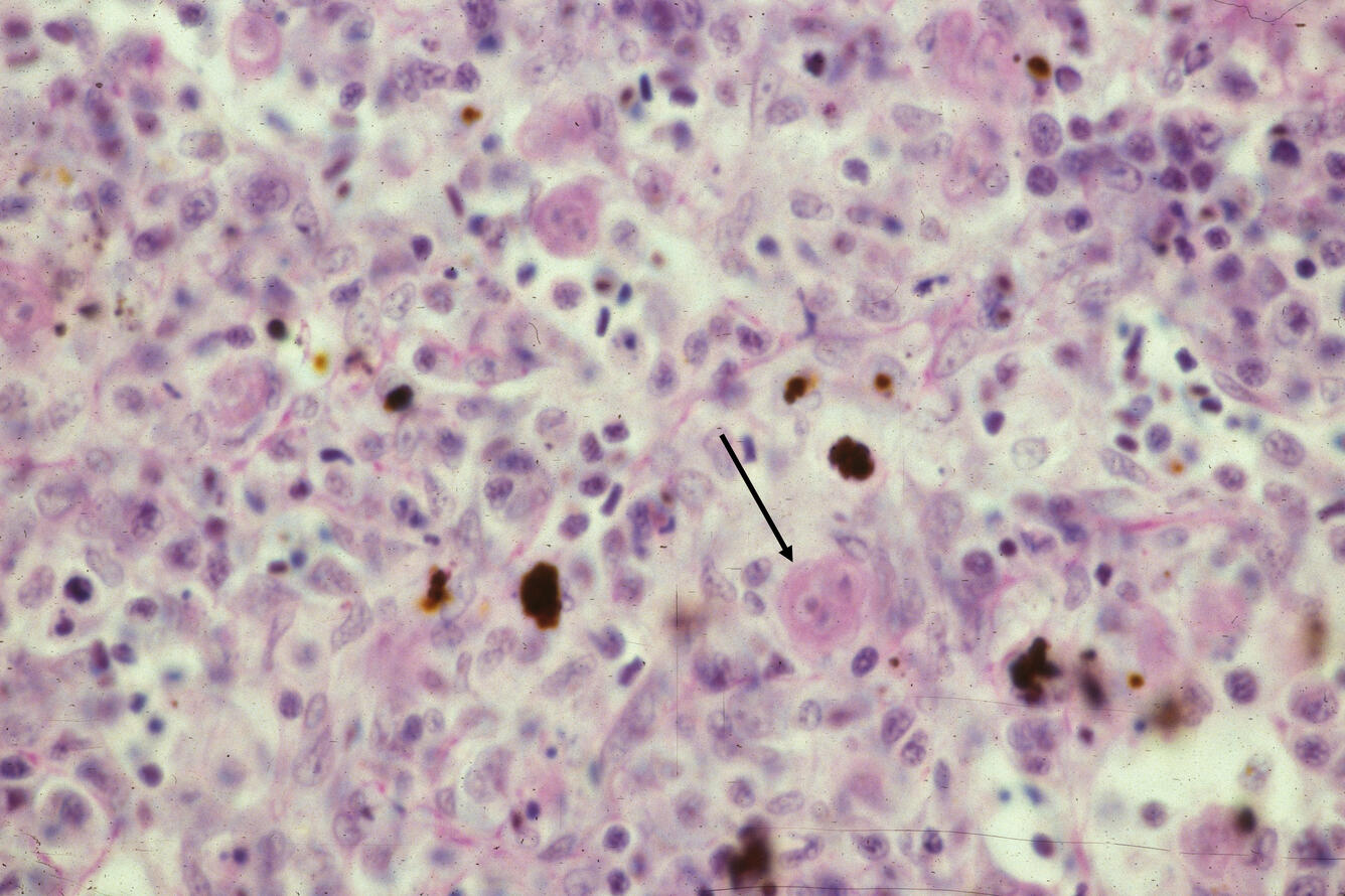 Proliferative kidney disease (PKD)