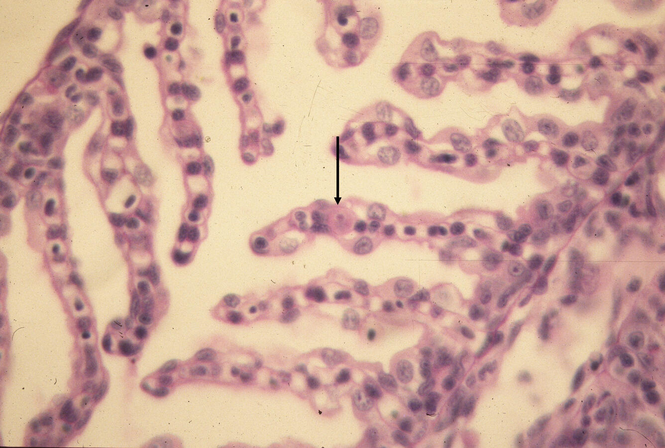 Proliferative kidney disease (PKD)