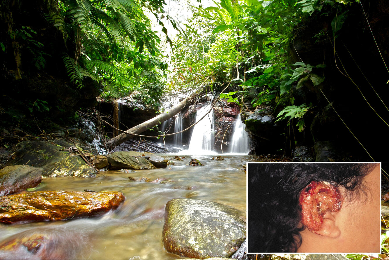 Contact with intact forest ecosystems can lead to cutaneous leishmaniasis, also known as "chiclero's ulcer"