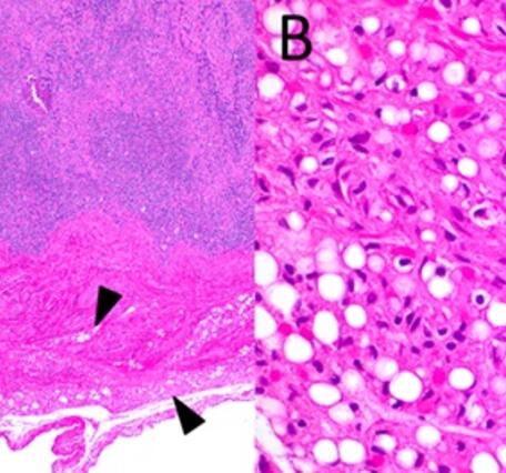 Emaciation with serous atrophy of fat in a Northern Sea Otter (Enhydra lutris)